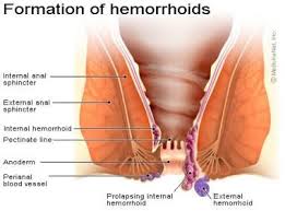 Treatment of Hemorrhoids